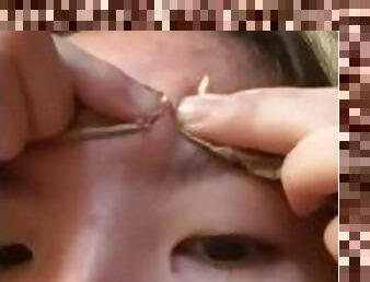 popping pimple :)