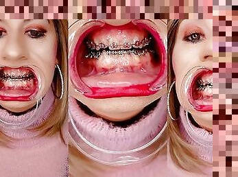 Braces fetish! See Alexandra Braces with an open mouth expander